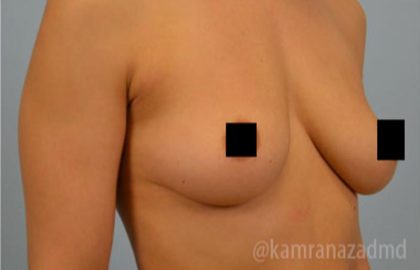 Breast Augmentation Before & After Patient #2150