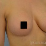 Breast Augmentation Before & After Patient #2150