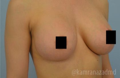 Breast Augmentation Before & After Patient #2150