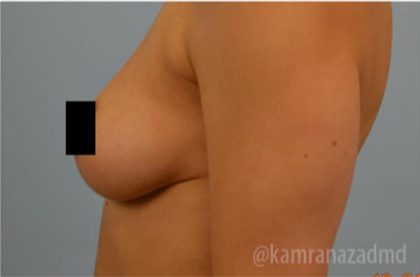 Breast Augmentation Before & After Patient #2150