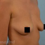 Breast Augmentation Before & After Patient #2151
