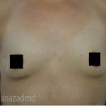 Breast Augmentation Before & After Patient #2152