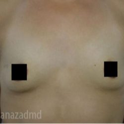 Breast Augmentation Before & After Patient #2152