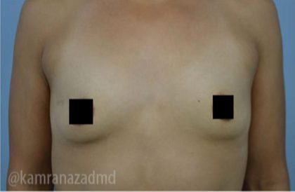 Breast Augmentation Before & After Patient #2152
