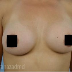 Breast Augmentation Before & After Patient #2152