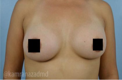 Breast Augmentation Before & After Patient #2152