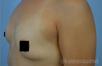 Breast Augmentation Before & After Patient #2152