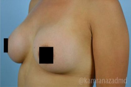 Breast Augmentation Before & After Patient #2152