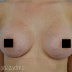 Breast Augmentation Before & After Patient #2153