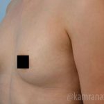 Breast Augmentation Before & After Patient #2153