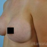 Breast Augmentation Before & After Patient #2153