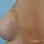 Breast Augmentation Before & After Patient #2153