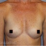 Breast Augmentation Before & After Patient #2154