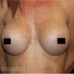 Breast Augmentation Before & After Patient #2154