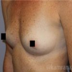 Breast Augmentation Before & After Patient #2154