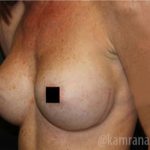 Breast Augmentation Before & After Patient #2154