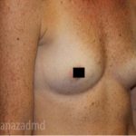 Breast Augmentation Before & After Patient #2154