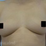 Breast Augmentation Before & After Patient #2155