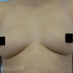 Breast Augmentation Before & After Patient #2155