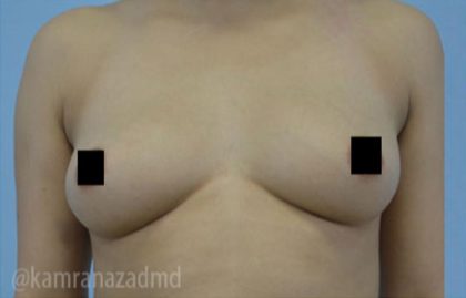 Breast Augmentation Before & After Patient #2155