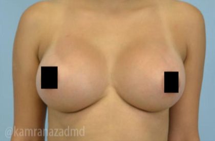 Breast Augmentation Before & After Patient #2155