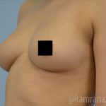 Breast Augmentation Before & After Patient #2155