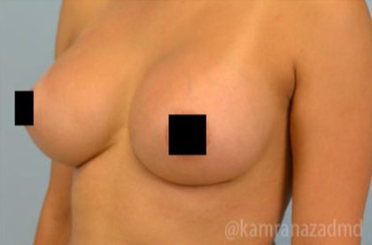 Breast Augmentation Before & After Patient #2155