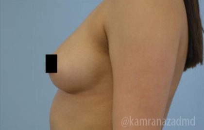 Breast Augmentation Before & After Patient #2155