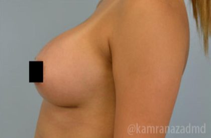 Breast Augmentation Before & After Patient #2155