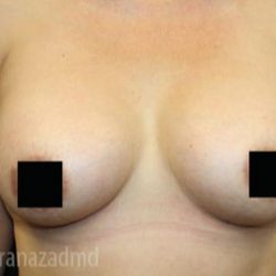 Breast Augmentation Before & After Patient #2119