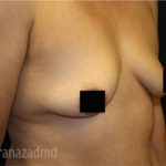 Breast Augmentation Before & After Patient #2119
