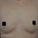 Breast Augmentation Before & After Patient #2156