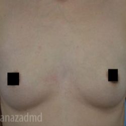 Breast Augmentation Before & After Patient #2156