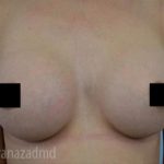 Breast Augmentation Before & After Patient #2156