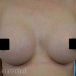 Breast Augmentation Before & After Patient #2156