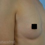 Breast Augmentation Before & After Patient #2156