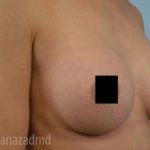 Breast Augmentation Before & After Patient #2156
