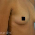Breast Augmentation Before & After Patient #2157