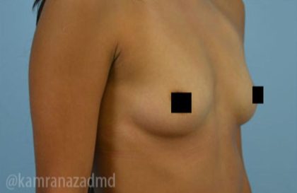 Breast Augmentation Before & After Patient #2157