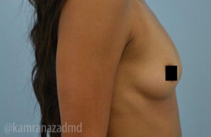 Breast Augmentation Before & After Patient #2157
