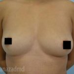 Breast Augmentation Before & After Patient #2158