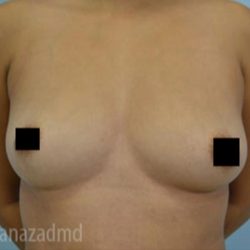 Breast Augmentation Before & After Patient #2158