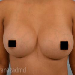 Breast Augmentation Before & After Patient #2158