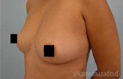 Breast Augmentation Before & After Patient #2158