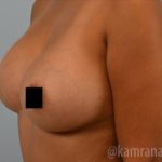 Breast Augmentation Before & After Patient #2158