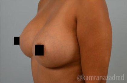 Breast Augmentation Before & After Patient #2158