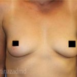 Breast Augmentation Before & After Patient #2162