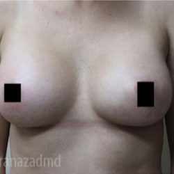 Breast Augmentation Before & After Patient #2162