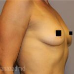 Breast Augmentation Before & After Patient #2162