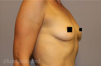 Breast Augmentation Before & After Patient #2162